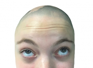 Diagnosed with alopecia areata, Isabel DiSalvo has an incurable form of hair loss. She shares her story with others to help other people learn about the condition.