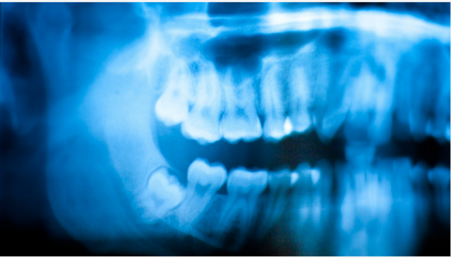 Getting wisdom teeth pulled, can cause relief from pain but is a painful process. 