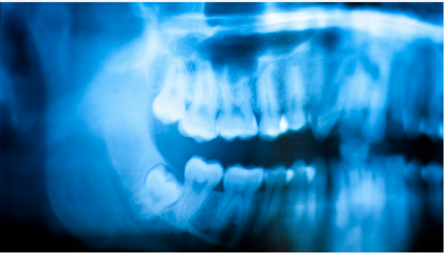 Getting+wisdom+teeth+pulled%2C+can+cause+relief+from+pain+but+is+a+painful+process.+